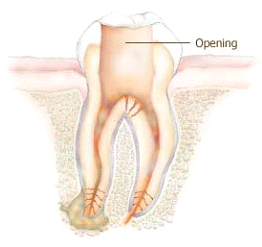 root-canal