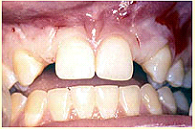 dental-implant