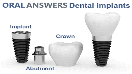 implants-answer