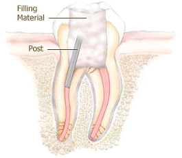 root-canal